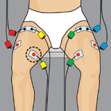 Compex Quad Pad Placement